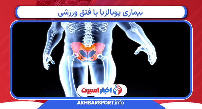 بیماری پوبالژیا یا فتق ورزشی