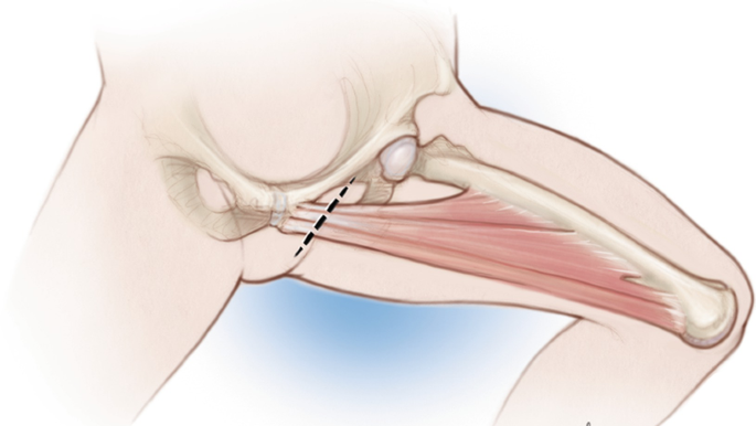 تشخیص بیماری پوبالژیا تشخیص بیماری پوبالژیا